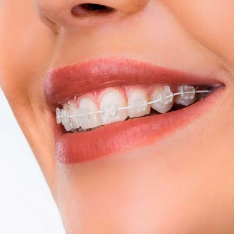 Brackets cerámicos estéticos
