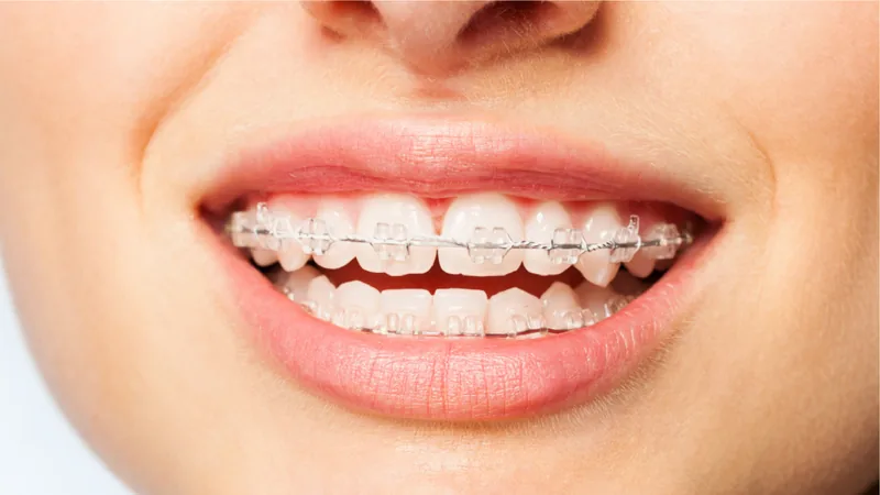 Brackets de cristal de zafiro