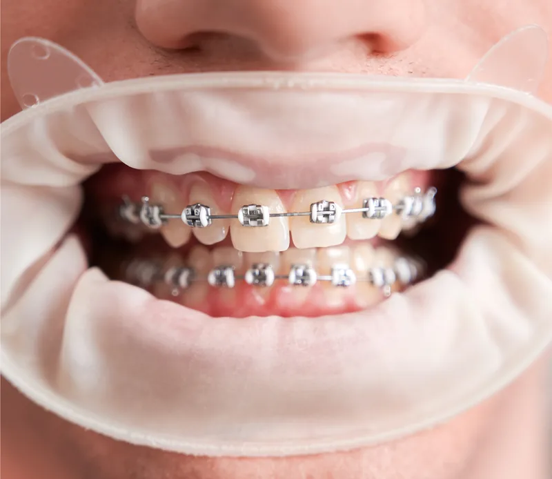 Brackets metálicos