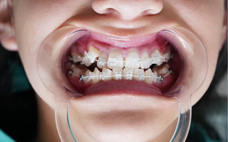 Brackets de autoligado Damon